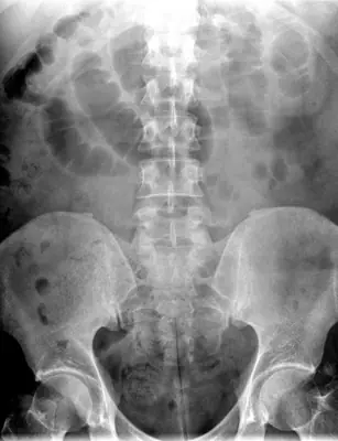 Radiograph from the case bank: Bowel obstruction