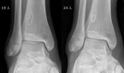 Radiograph from the case bank: Non-ossifying fibroma