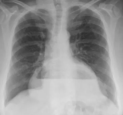 Radiograph from the case bank: Hiatus hernia