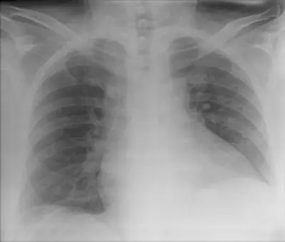 Radiograph from the case bank: Chilaiditi sign (colon interposed under the diaphragm)