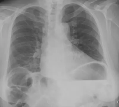 Radiograph from the case bank: Chilaiditi sign (colon interposed under the diaphragm)