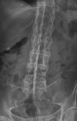 Radiograph from the case bank: Ankylosing spondylitis