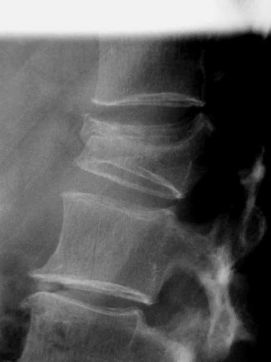 Spine radiograph for self-assessment