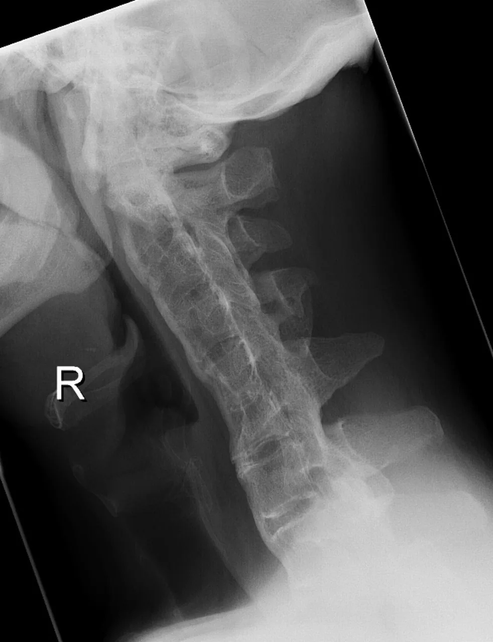 Spine radiograph for self-assessment