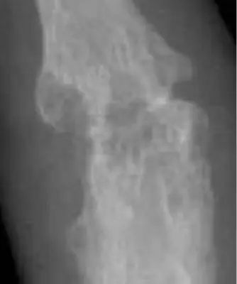 Radiograph from the case bank: Rheumatoid arthritis