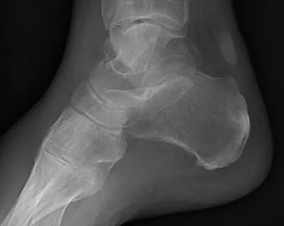 Radiograph from the case bank: Calcaneal fracture