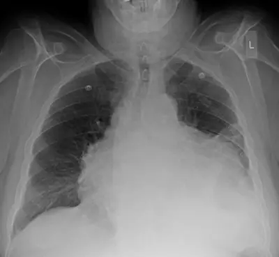 Radiograph from the case bank: Pericardial effusion