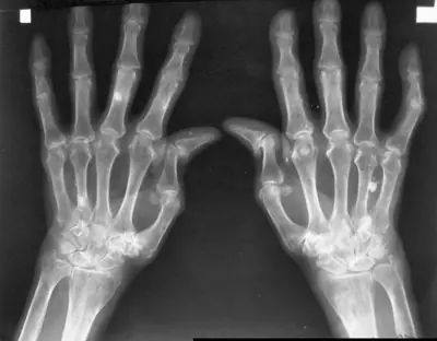 Radiograph from the case bank: Rheumatoid arthritis