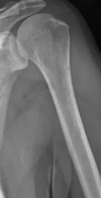 Radiograph from the case bank: Multiple myeloma