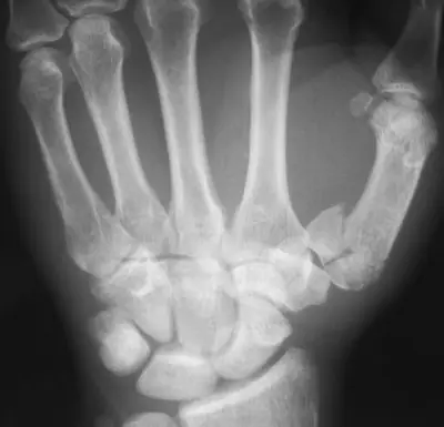 Radiograph from the case bank: Rolando fracture