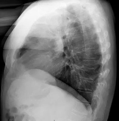 Radiograph from the case bank: Implanted venous access port (port-a-cath)