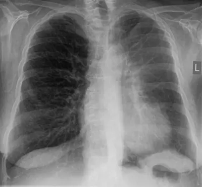 Radiograph from the case bank: Lung collapse (atelectasis)