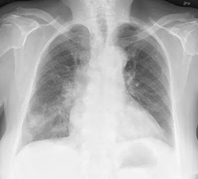 Radiograph from the case bank: Pneumonia (consolidation)