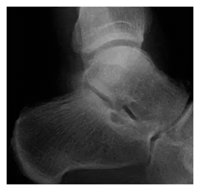 Radiograph from the case bank: Stress fracture