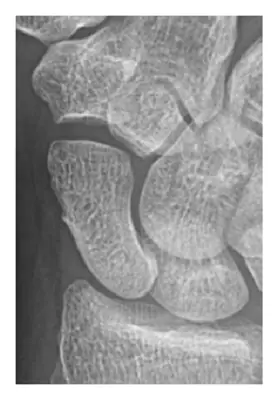 Radiograph from the case bank: Scaphoid fracture