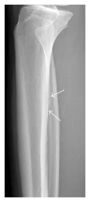 Radiograph from the case bank: Stress fracture