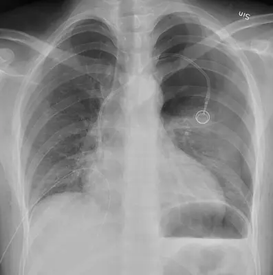 Radiograph from the case bank: Pneumothorax