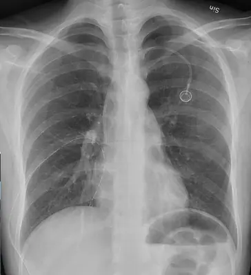 Radiograph from the case bank: Pneumothorax