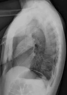 Radiograph from the case bank: Pneumothorax