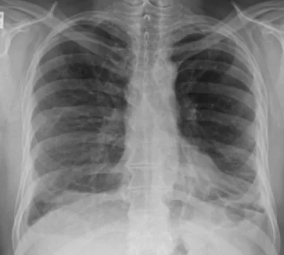 Chest radiograph for self-assessment