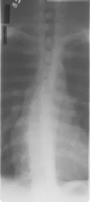 Radiograph from the case bank: Scoliosis
