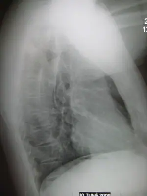 Radiograph from the case bank: Normal chest radiograph