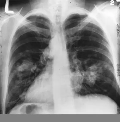 Radiograph from the case bank: Lung cancer (mass)