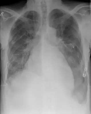 Radiograph from the case bank: Pneumothorax