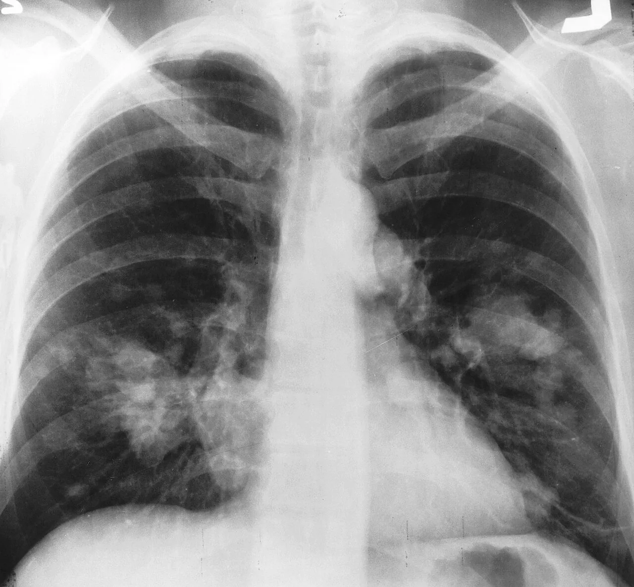 Chest radiograph for self-assessment