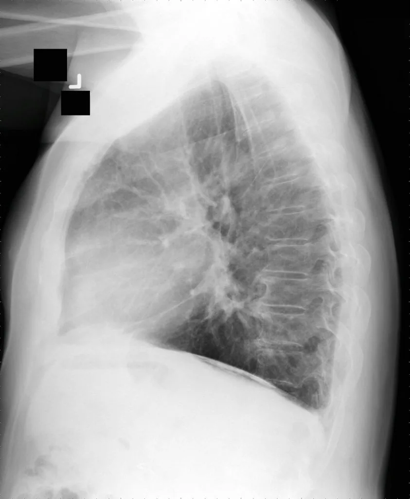 Chest radiograph for self-assessment