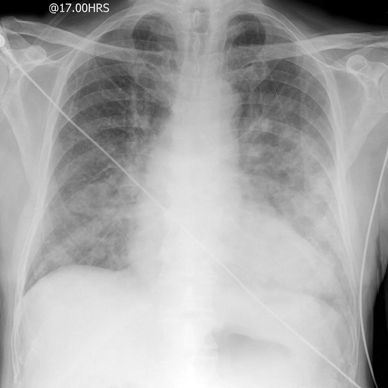 Chest radiograph for self-assessment
