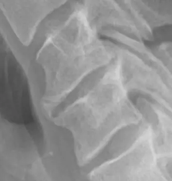 Radiograph from the case bank: Degenerative spondylosis