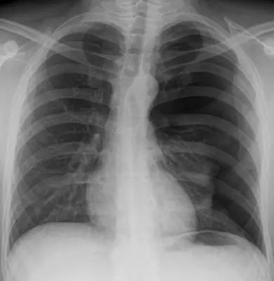 Radiograph from the case bank: Pneumothorax