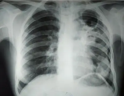 Radiograph from the case bank: Pulmonary tuberculosis