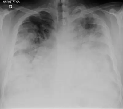 Radiograph from the case bank: Pneumonia (consolidation)