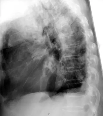 Radiograph from the case bank: Pneumonia (consolidation)