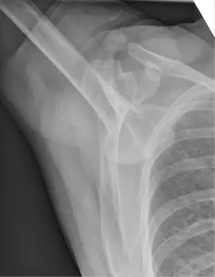 Radiograph from the case bank: Shoulder (glenohumeral) dislocation