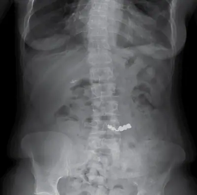 Radiograph from the case bank: Foreign body (ingested or inserted)