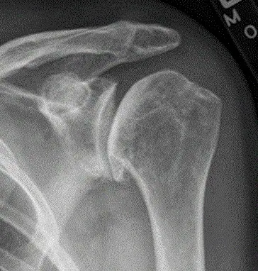 Radiograph from the case bank: Osteoarthritis