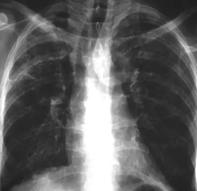 Radiograph from the case bank: Pneumocystis pneumonia (PCP)