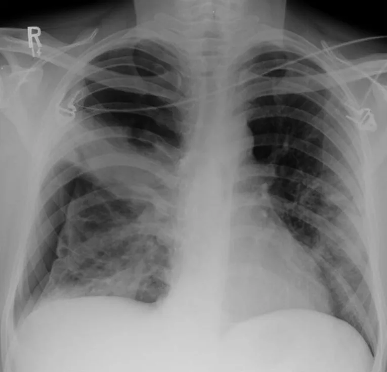 Chest radiograph for self-assessment