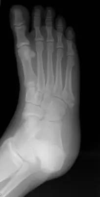 Radiograph from the case bank: Fifth metatarsal fracture (Jones / base)