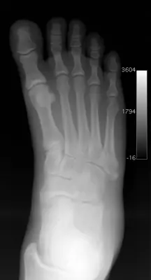 Radiograph from the case bank: Fifth metatarsal fracture (Jones / base)
