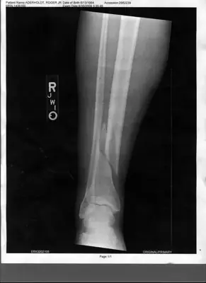 Radiograph from the case bank: Tibial (and fibular) shaft fracture