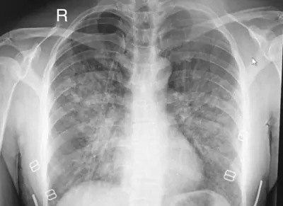 Radiograph from the case bank: Pulmonary oedema (heart failure)