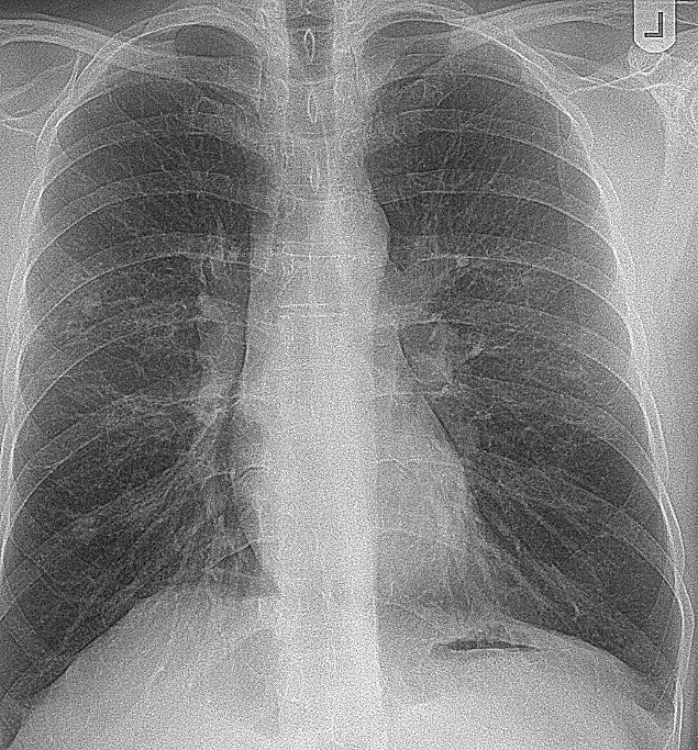 Chest radiograph for self-assessment