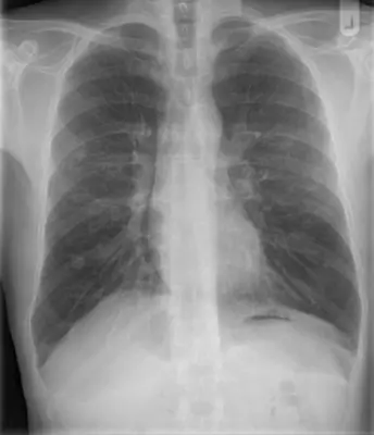 Radiograph from the case bank: Sarcoidosis