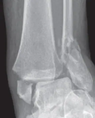 Radiograph from the case bank: Bimalleolar ankle fracture