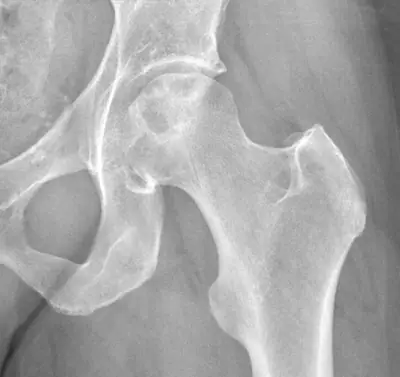 Radiograph from the case bank: Avascular necrosis of the femoral head
