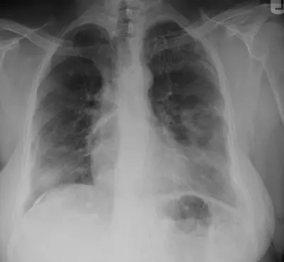Radiograph from the case bank: Asbestos-related pleural disease